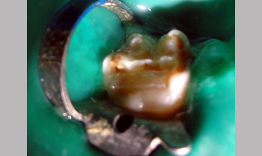 Cosmetic dentistry treatment in Anand
                        